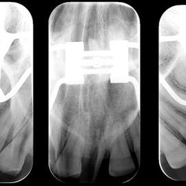 radiografia-oclusal